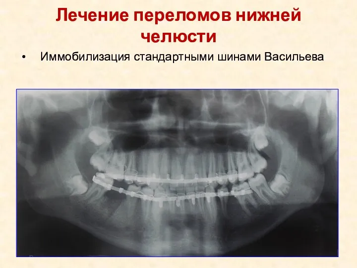 Лечение переломов нижней челюсти Иммобилизация стандартными шинами Васильева