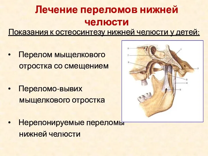 Показания к остеосинтезу нижней челюсти у детей: Перелом мыщелкового отростка