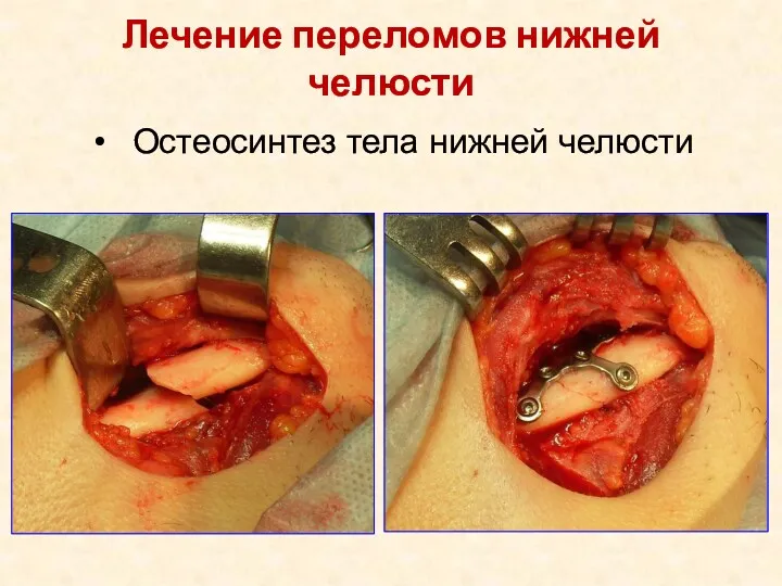 Лечение переломов нижней челюсти Остеосинтез тела нижней челюсти