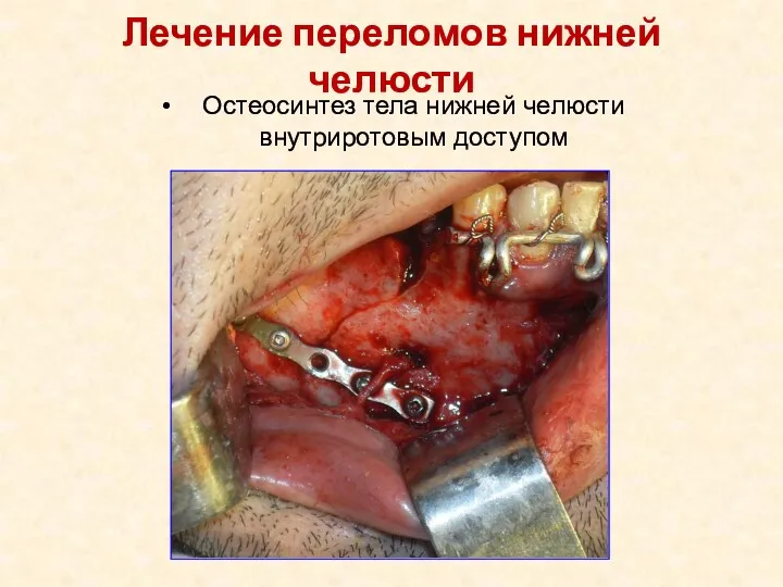 Лечение переломов нижней челюсти Остеосинтез тела нижней челюсти внутриротовым доступом