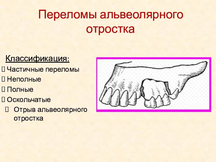 Классификация: Частичные переломы Неполные Полные Оскольчатые Отрыв альвеолярного отростка Переломы альвеолярного отростка