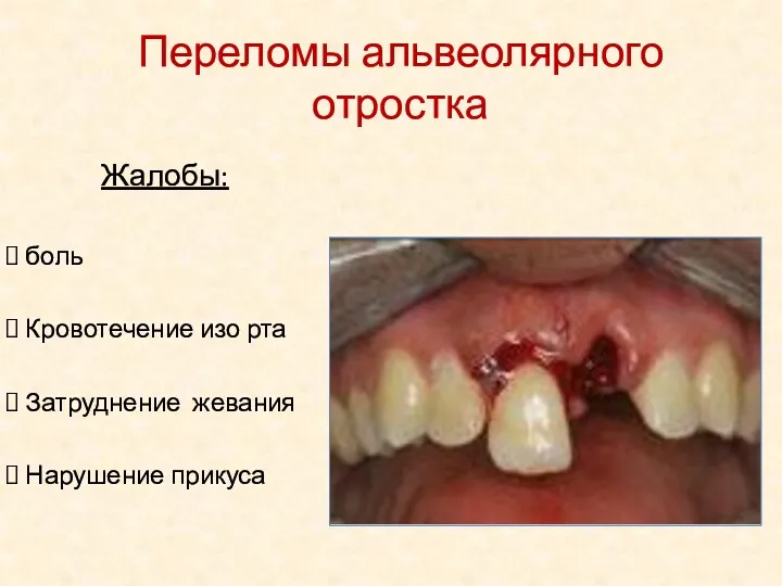 Жалобы: боль Кровотечение изо рта Затруднение жевания Нарушение прикуса Переломы альвеолярного отростка
