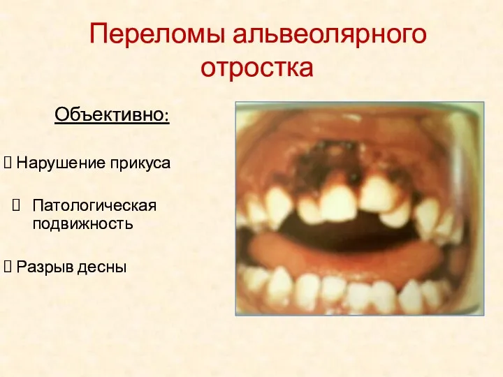 Объективно: Нарушение прикуса Патологическая подвижность Разрыв десны Переломы альвеолярного отростка