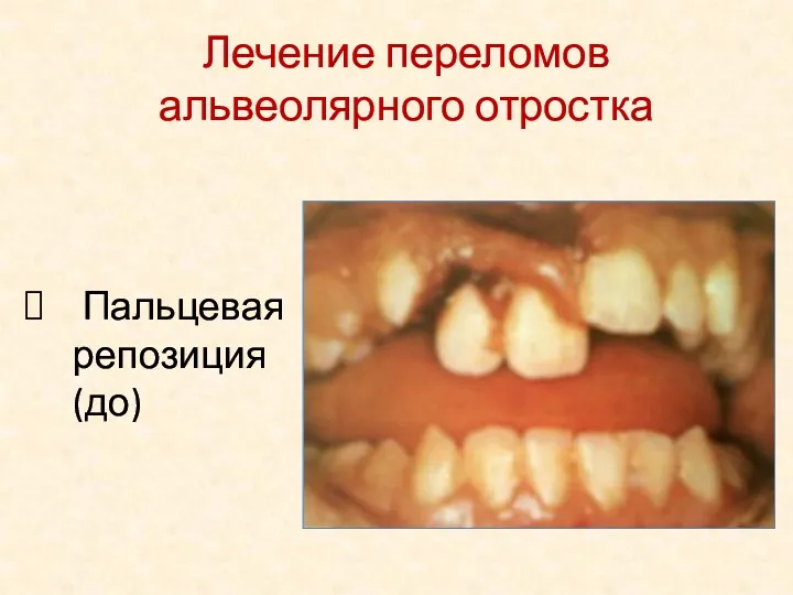 Пальцевая репозиция (до) Лечение переломов альвеолярного отростка