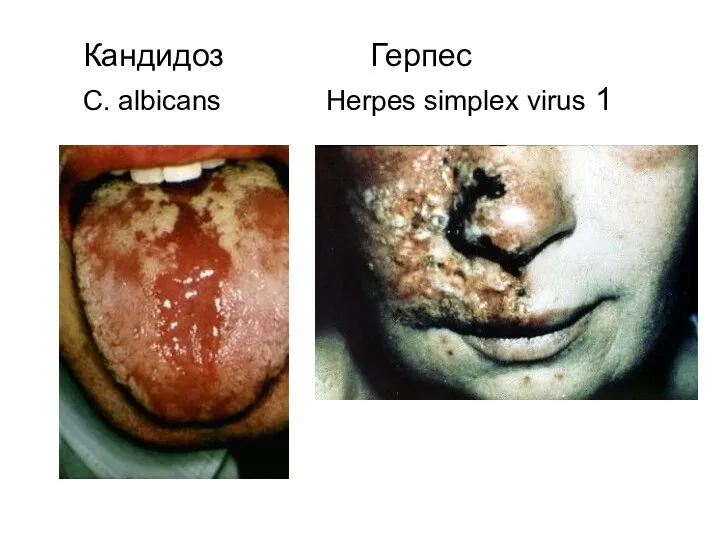 Кандидоз Герпес C. albicans Herpes simplex virus 1