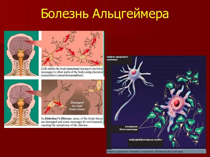 Болезнь Альцгеймера