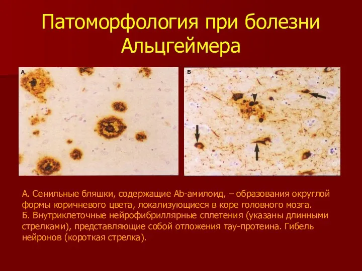 Патоморфология при болезни Альцгеймера А. Сенильные бляшки, содержащие Аb-амилоид, –