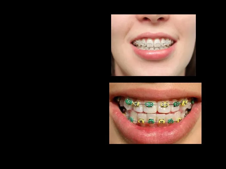 ЛЕЧЕНИЕ Устранение аномалий прикуса и дефектов зубов производится методами ортодонтии