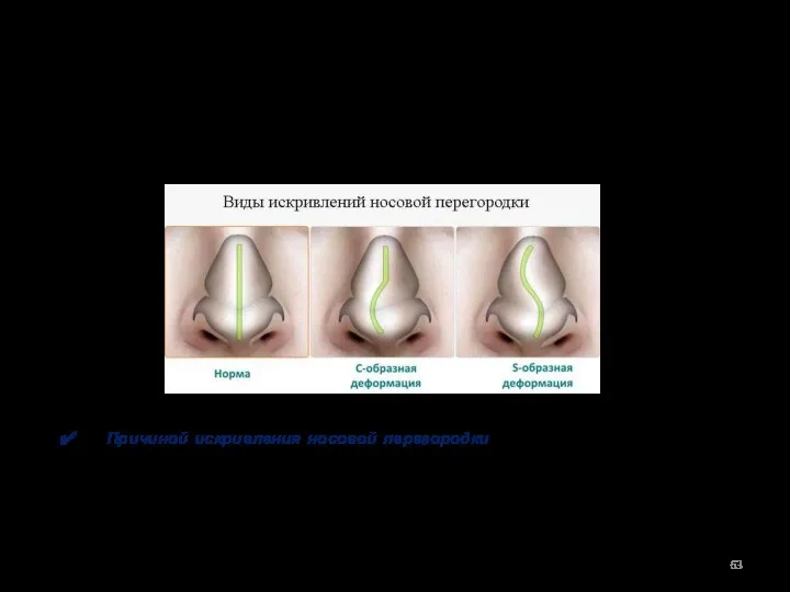 I. ЗАБОЛЕВАНИЯ НАРУЖНОГО НОСА И НОСОВОЙ ПОЛОСТИ. Искривление носовой перегородки.