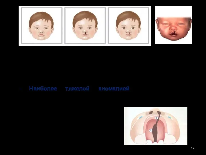 При расщелинах губы наблюдаются также аномалии расположения числа зубов. Наиболее