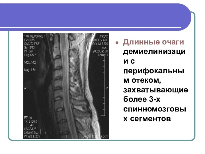 Длинные очаги демиелинизации с перифокальным отеком, захватывающие более 3-х спинномозговых сегментов