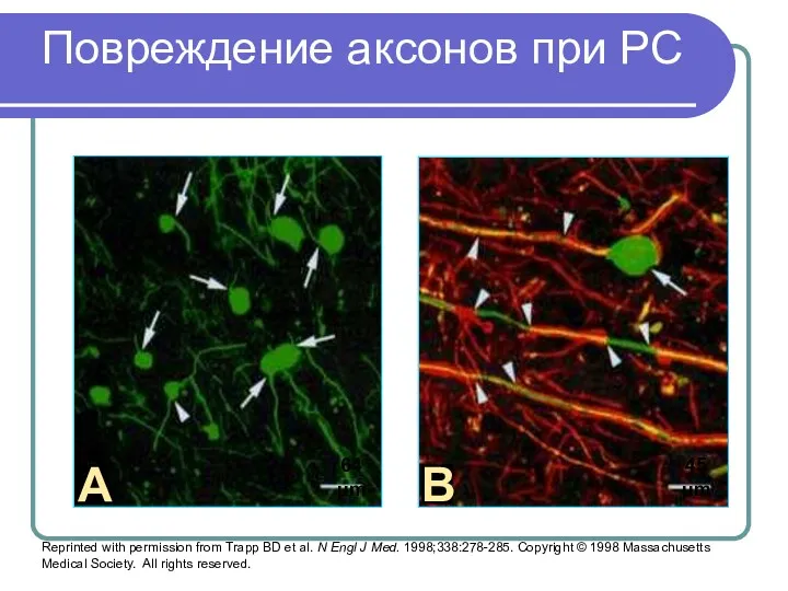 Повреждение аксонов при РС Reprinted with permission from Trapp BD