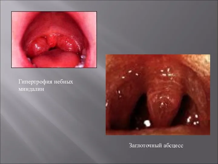 Заглоточный абсцесс Гипертрофия небных миндалин