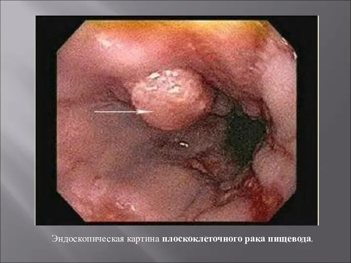 Эндоскопическая картина плоскоклеточного рака пищевода.