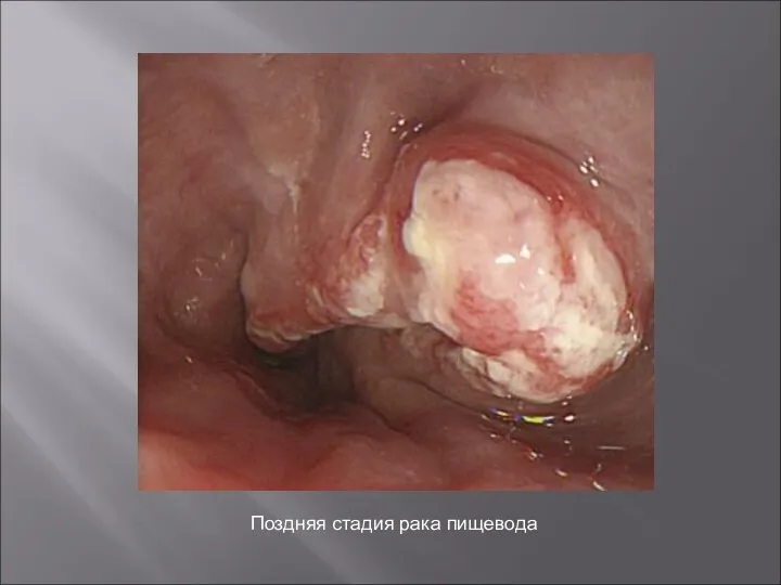 Поздняя стадия рака пищевода