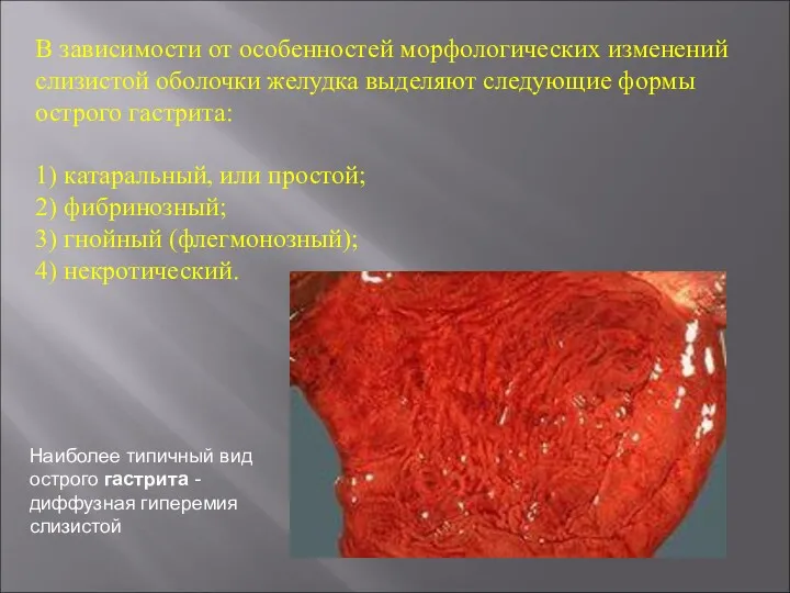 В зависимости от особенностей морфологических изменений слизистой оболочки желудка выделяют следующие формы острого