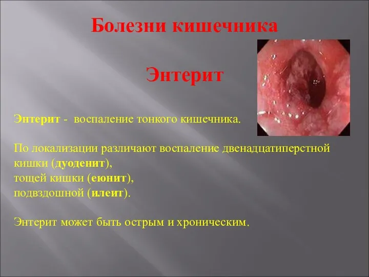 Болезни кишечника Энтерит Энтерит - воспаление тонкого кишечника. По локализации