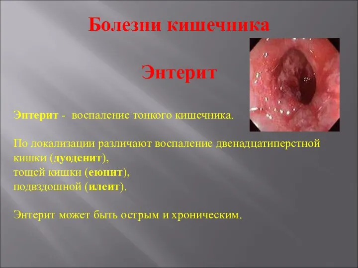 Болезни кишечника Энтерит Энтерит - воспаление тонкого кишечника. По локализации различают воспаление двенадцатиперстной