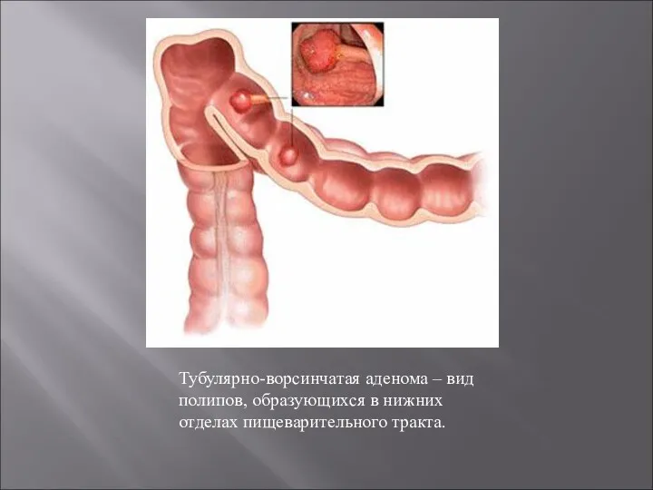 Тубулярно-ворсинчатая аденома – вид полипов, образующихся в нижних отделах пищеварительного тракта.
