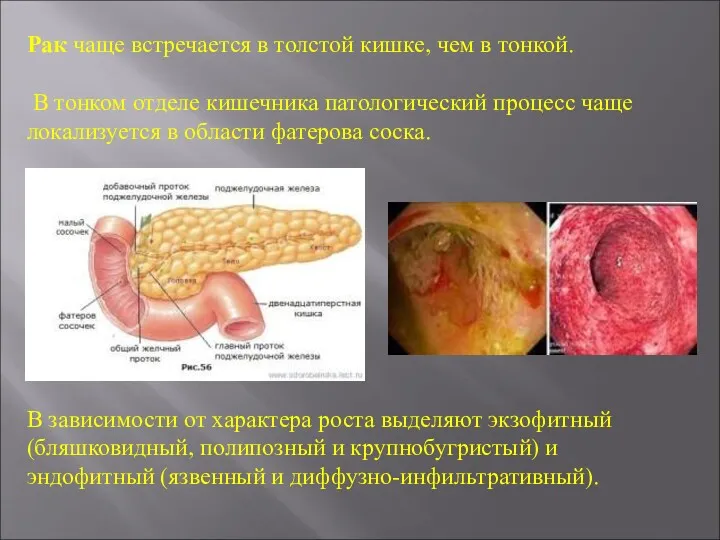 Рак чаще встречается в толстой кишке, чем в тонкой. В тонком отделе кишечника