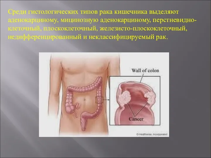 Среди гистологических типов рака кишечника выделяют аденокарциному, мицинозную аденокарциному, перстневидно-клеточный, плоскоклеточный, железисто-плоскоклеточный, недифференцированный и неклассифицируемый рак.