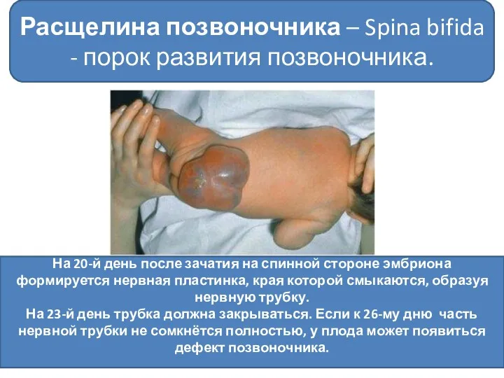 Расщелина позвоночника – Spina bifida - порок развития позвоночника. На