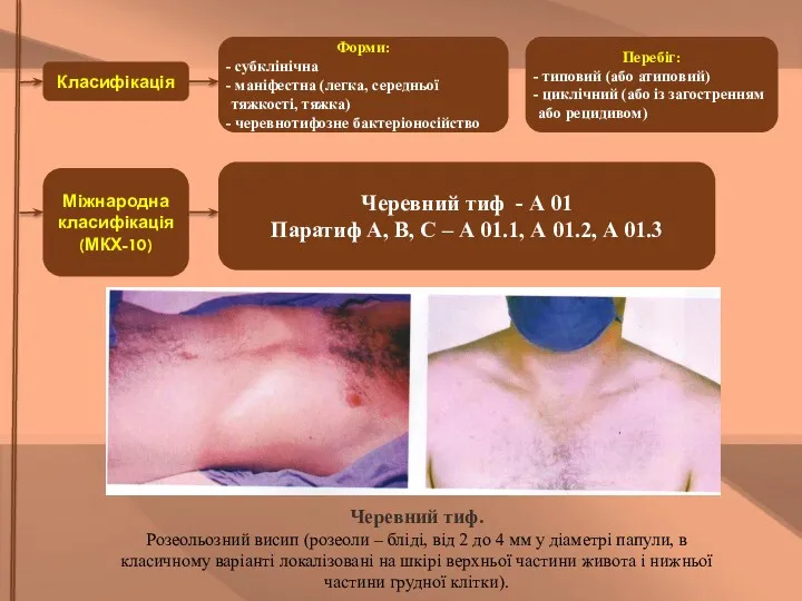 Класифікація Перебіг: типовий (або атиповий) циклічний (або із загостренням або рецидивом) Форми: субклінічна