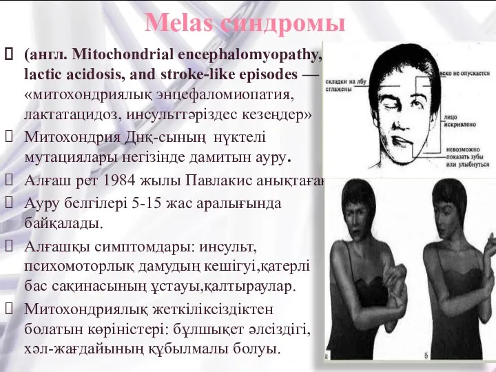 Melas синдромы (англ. Mitochondrial encephalomyopathy, lactic acidosis, and stroke-like episodes