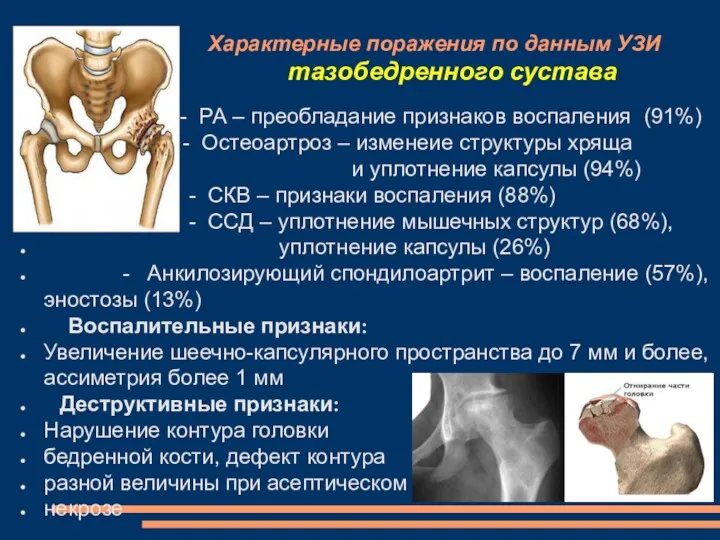 Характерные поражения по данным УЗИ тазобедренного сустава - РА –