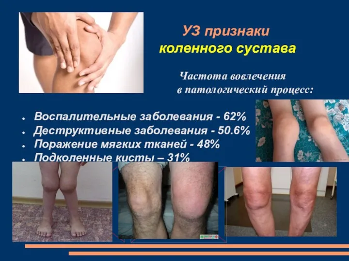 УЗ признаки коленного сустава Частота вовлечения в патологический процесс: Воспалительные