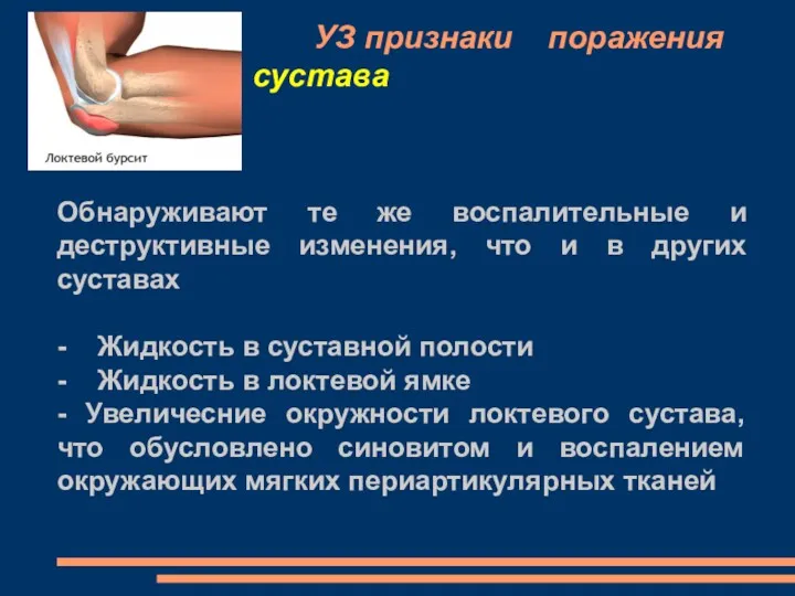 УЗ признаки поражения локтевого сустава Обнаруживают те же воспалительные и