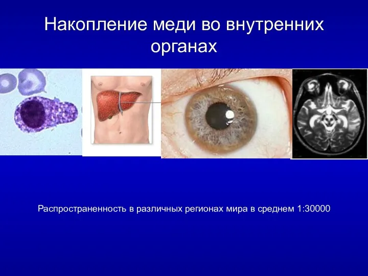 Накопление меди во внутренних органах Распространенность в различных регионах мира в среднем 1:30000