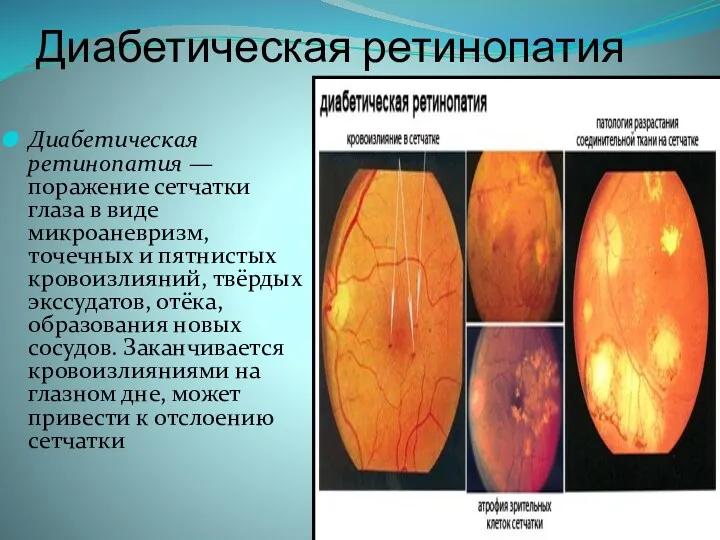 Диабетическая ретинопатия Диабетическая ретинопатия — поражение сетчатки глаза в виде