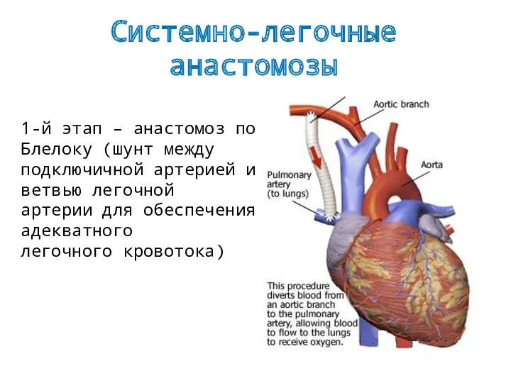 Системно-легочные анастомозы 1-й этап – анастомоз по Блелоку (шунт между