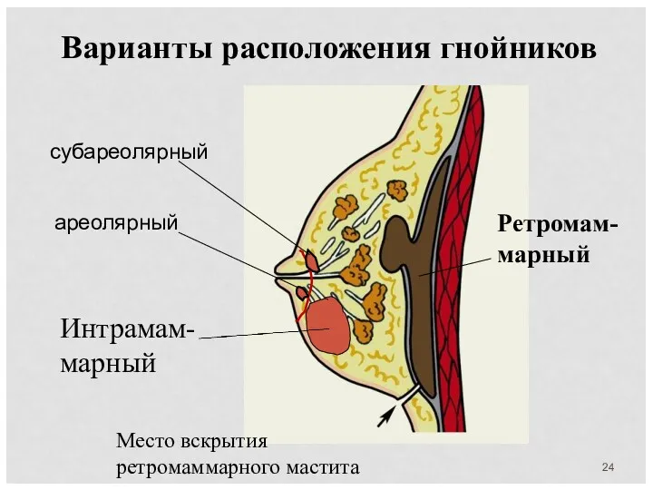 Ретромам-марный субареолярный ареолярный Интрамам- марный Место вскрытия ретромаммарного мастита Варианты расположения гнойников