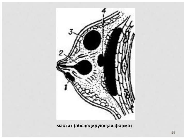 мастит (абсцедирующая форма).