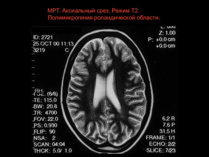 МРТ. Аксиальный срез. Режим Т2. Полимикрогения роландической области.