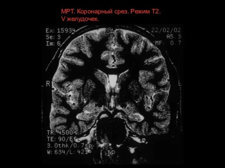 МРТ. Коронарный срез. Режим Т2. V желудочек.