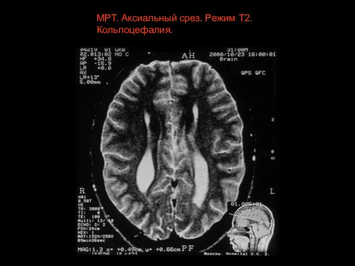 МРТ. Аксиальный срез. Режим Т2. Кольпоцефалия.