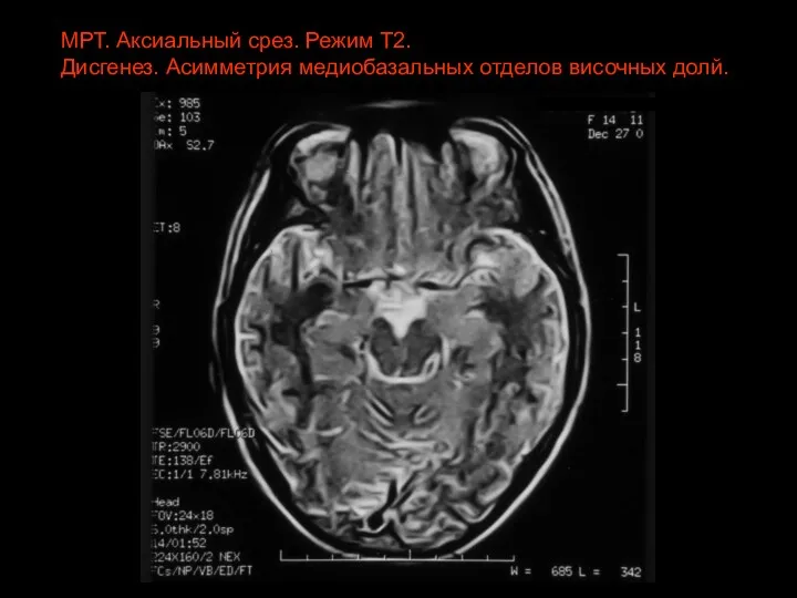 МРТ. Аксиальный срез. Режим Т2. Дисгенез. Асимметрия медиобазальных отделов височных долй.