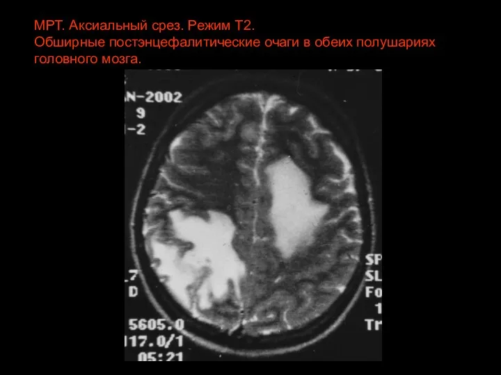 МРТ. Аксиальный срез. Режим Т2. Обширные постэнцефалитические очаги в обеих полушариях головного мозга.