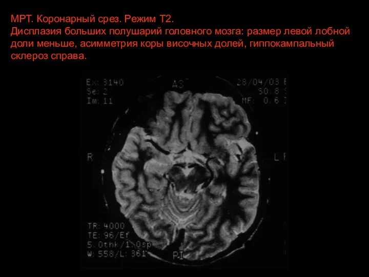 МРТ. Коронарный срез. Режим Т2. Дисплазия больших полушарий головного мозга: