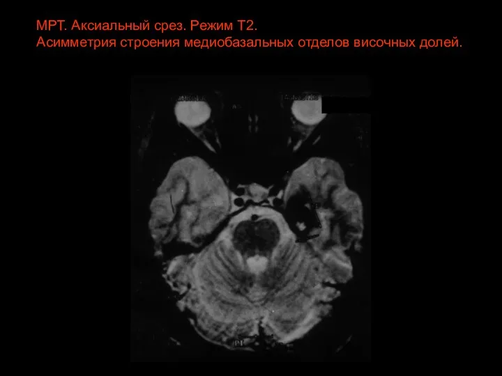 МРТ. Аксиальный срез. Режим Т2. Асимметрия строения медиобазальных отделов височных долей.