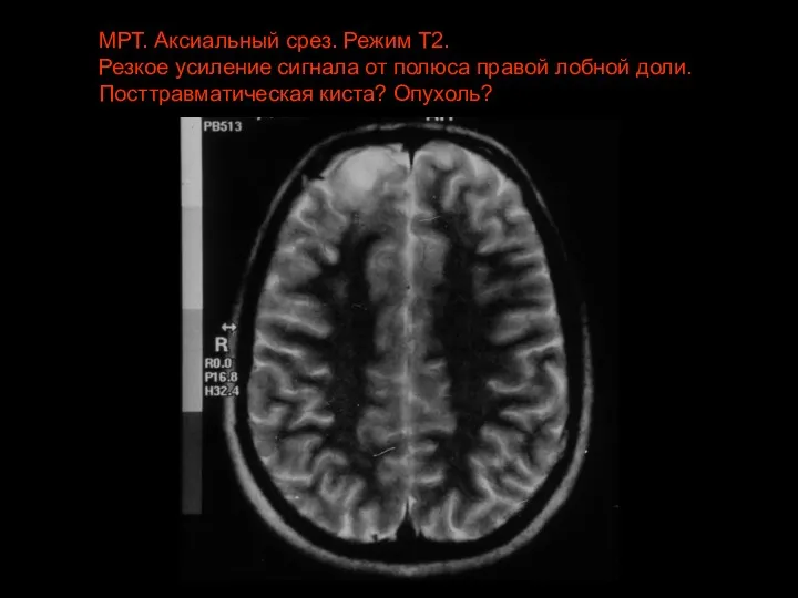 МРТ. Аксиальный срез. Режим Т2. Резкое усиление сигнала от полюса правой лобной доли. Посттравматическая киста? Опухоль?