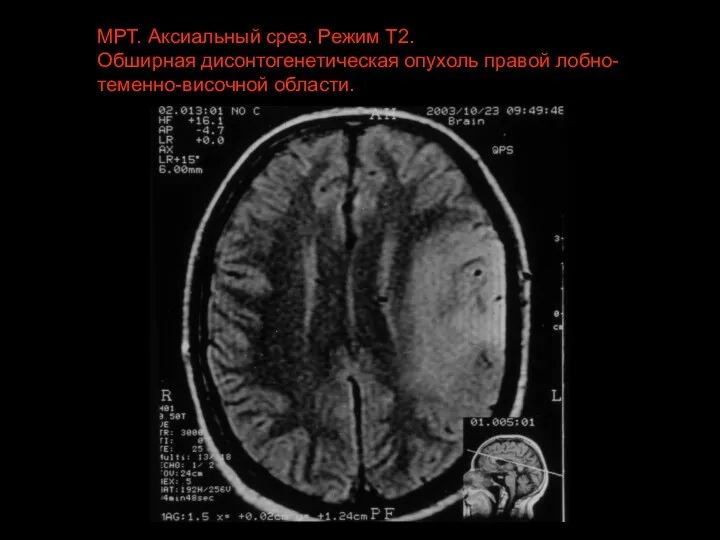 МРТ. Аксиальный срез. Режим Т2. Обширная дисонтогенетическая опухоль правой лобно-теменно-височной области.