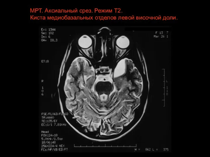 МРТ. Аксиальный срез. Режим Т2. Киста медиобазальных отделов левой височной доли.