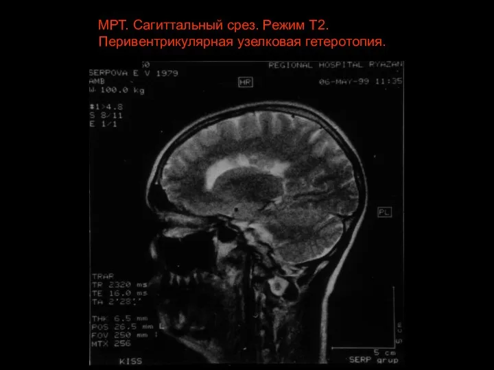 МРТ. Сагиттальный срез. Режим Т2. Перивентрикулярная узелковая гетеротопия.