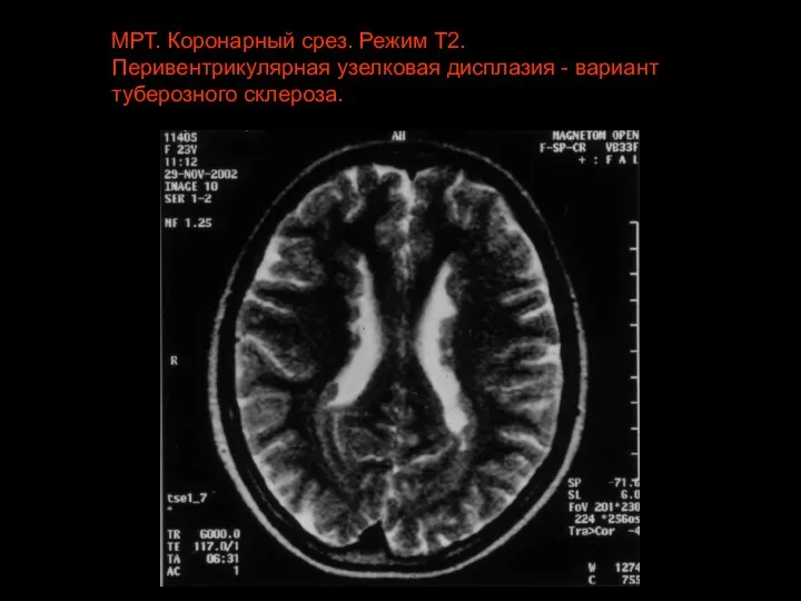 МРТ. Коронарный срез. Режим Т2. Перивентрикулярная узелковая дисплазия - вариант туберозного склероза.