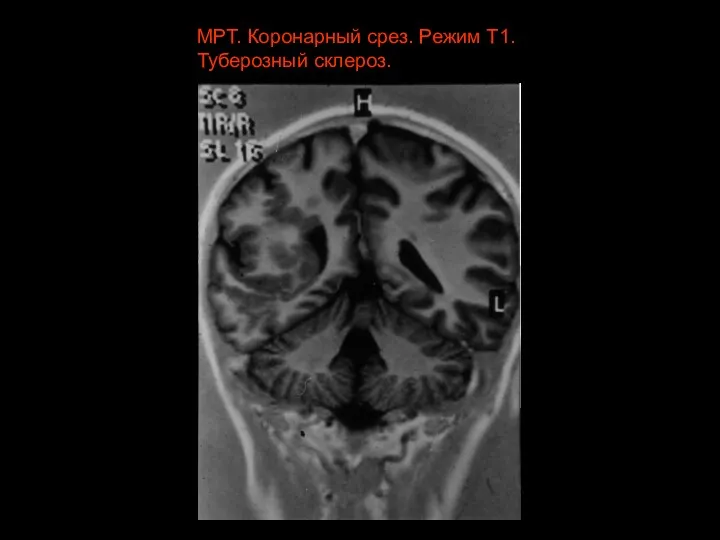 МРТ. Коронарный срез. Режим Т1. Туберозный склероз.