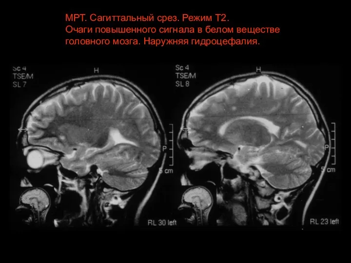 МРТ. Сагиттальный срез. Режим Т2. Очаги повышенного сигнала в белом веществе головного мозга. Наружняя гидроцефалия.